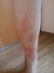 Piel atopica